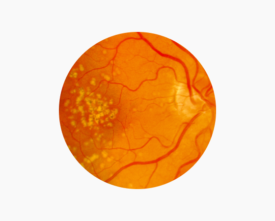 건성 황반변성 이미지