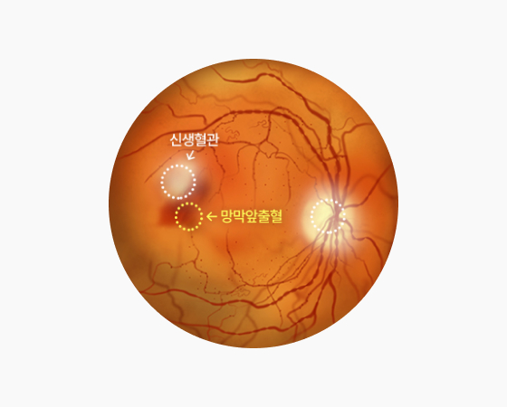 증식성 당뇨 망막병증