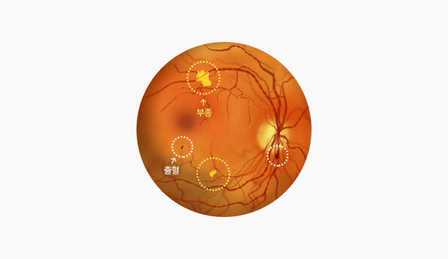 비증식성 당뇨 망막병증