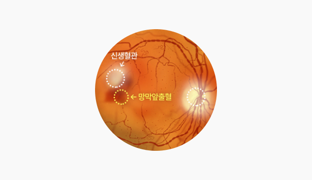 증식성 당뇨 망막병증