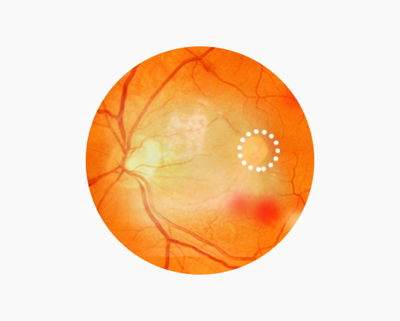 삼출성 망막박리