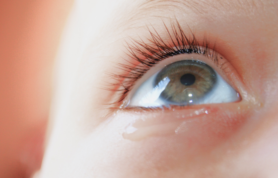 선천성 눈물길 폐쇄 이미지